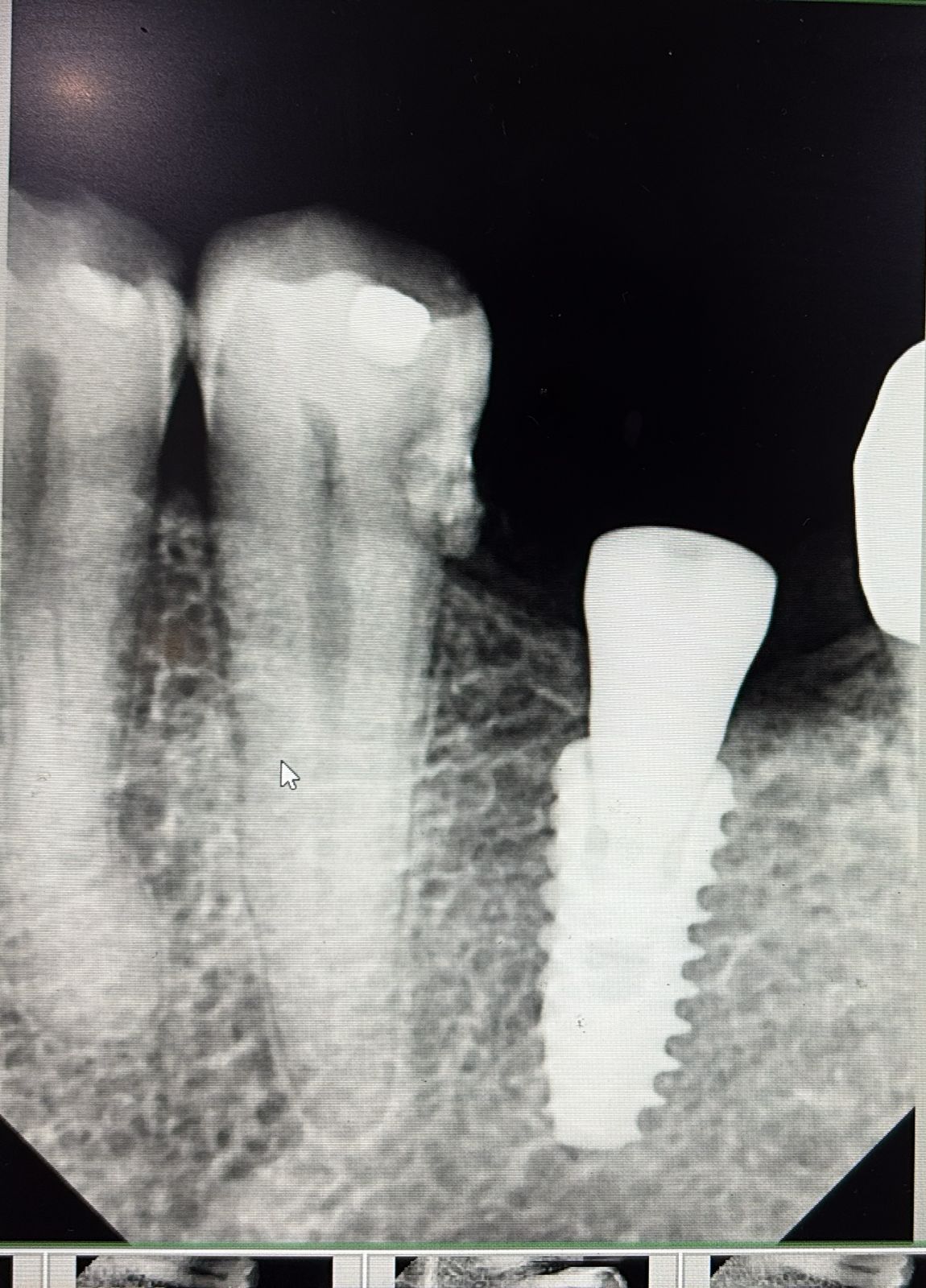 Successful X-Ray Implants
